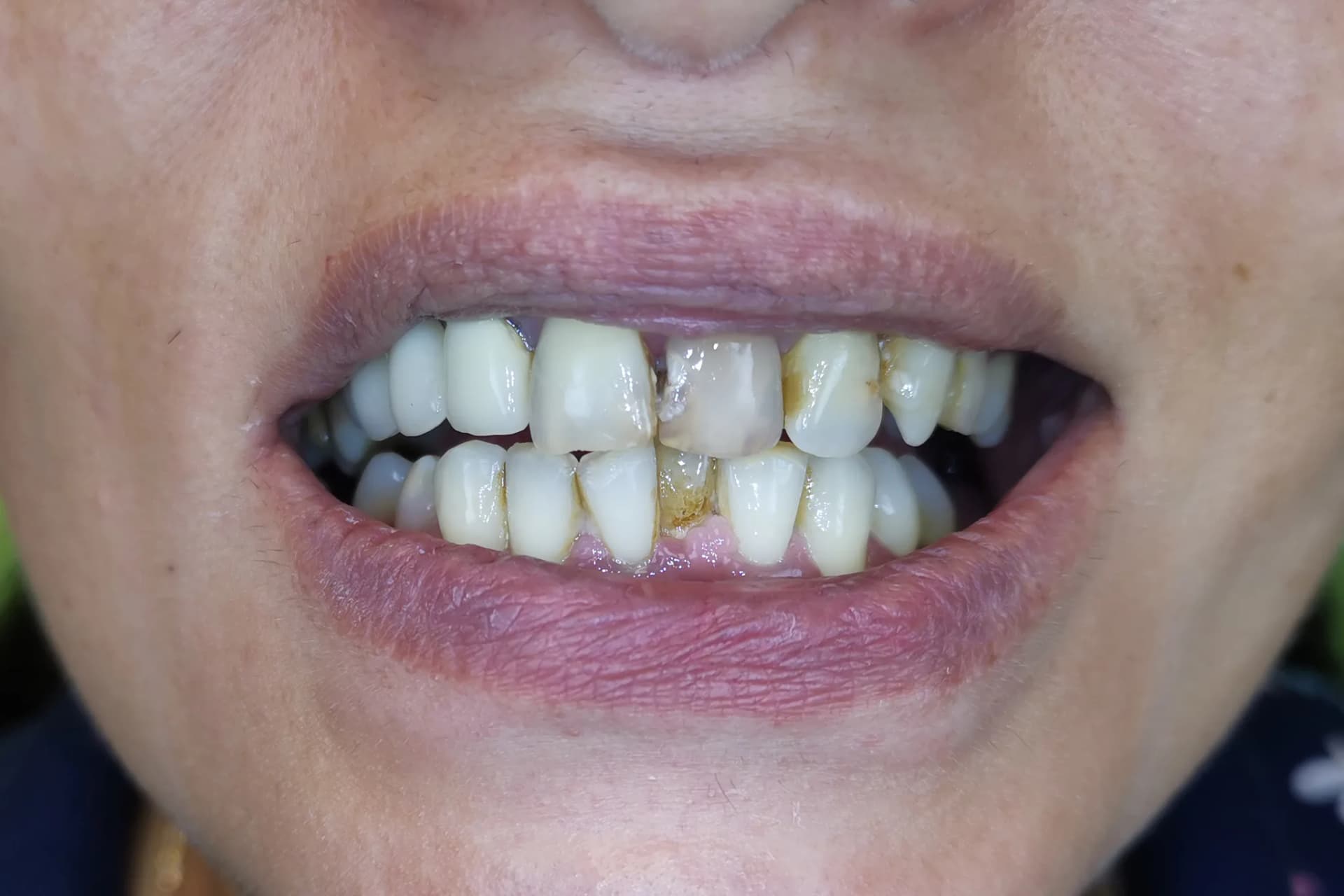 Възстановяване с циркониеви коронки - снимка 1 от 8